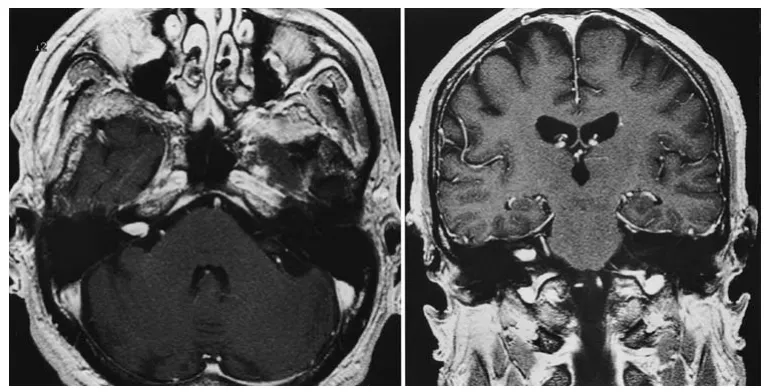 右侧内听道内有一个1厘米的肿瘤，并向右侧桥小脑角池延伸3毫米
