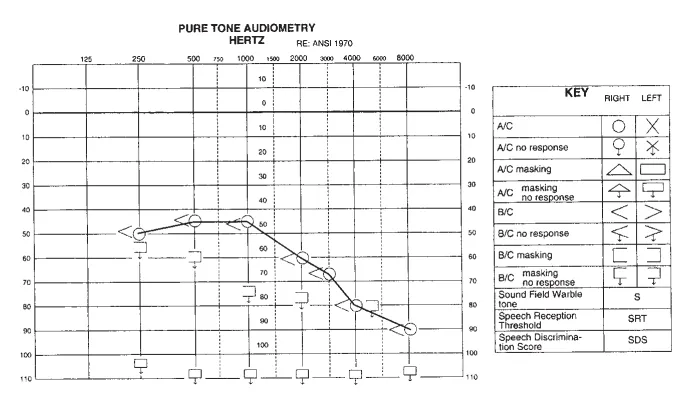 术前听力图显示，左耳为重度感音神经性听力损失，右耳在低频呈中度感音神经性听力损失，并随频率增高呈下斜型下降至高频率重度听力损失。