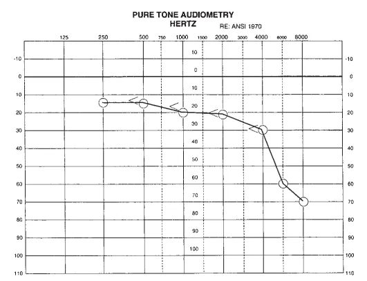 术后1周听力图显示，右耳听力显著改善。在1000Hz以内听力正常，在2000至8000Hz频率范围内呈轻至中度感音神经性听力损失。