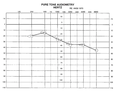 术后5个月听力图显示，听力得到进一步改善。在2000Hz以内听力正常，在4000至8000Hz频率范围内呈轻至中度感音神经性听力损失。