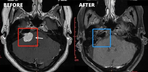 全切肿瘤 + 完美保留面听功能