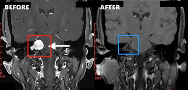 术前术后MRI对比