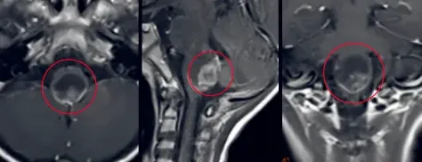 鉴于肿瘤位置特殊、二次手术可能导致呼吸衰竭或高位截瘫，医生大多建议继续保守观察。