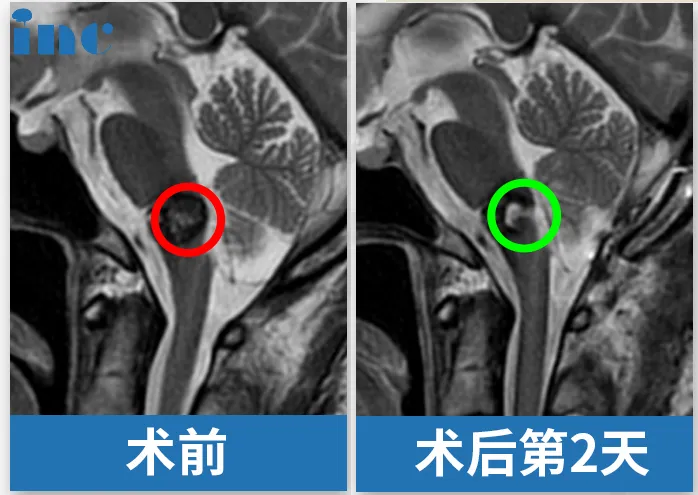 延髓海绵状血管瘤被顺利全切，且术后没有出现任何新的神经功能损伤。