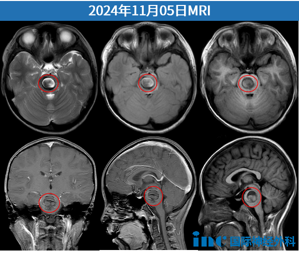 从死神手里救回来的脑干肿瘤女孩，再见到了巴爷爷：如今鲜活开朗、成绩优异