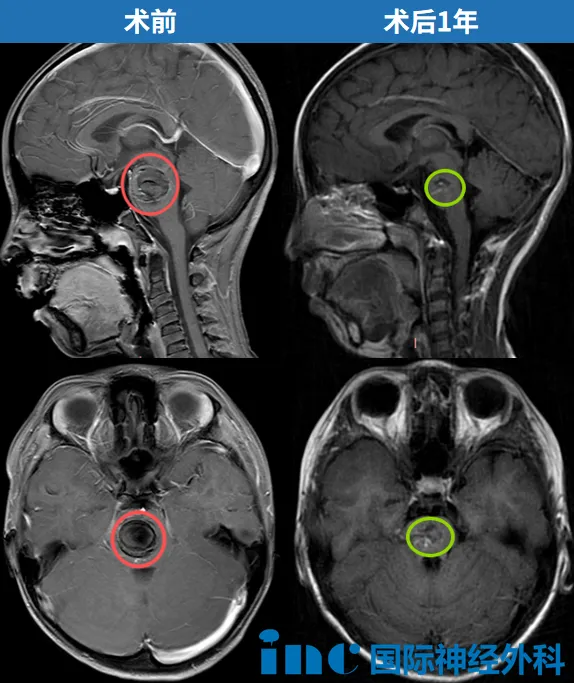 术前术后MRI对比