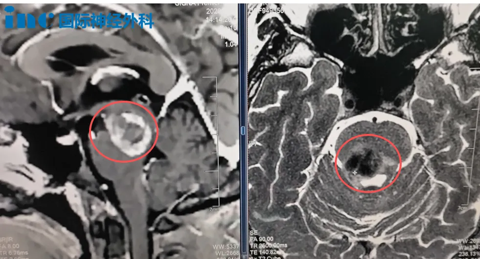 INC巴特朗菲教授主刀、国内神经外科医生团队全力配合下，突破“生命禁区”，顺利完成一台高难度脑干海绵状血管瘤示范手术，血管瘤全切。