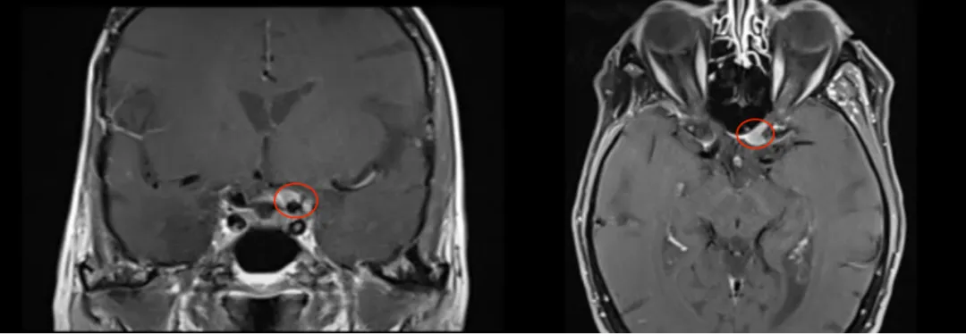 术前MRI影像，显示左侧视神经管内侧病变均匀增强，脑膜瘤位于视神经管的中下侧