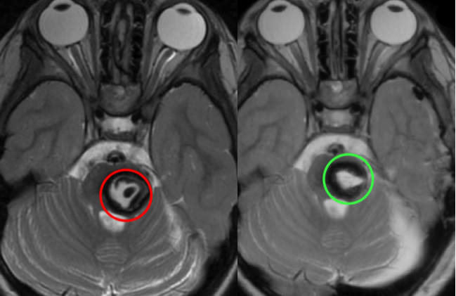 术后即时影像学复查证实：病变实现镜下全切，术区无新发出血、水肿，瘤腔内可见止血材料正常显影。