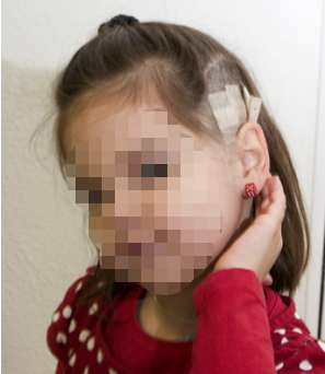 术后影像学确认全切后，晶晶无需进一步辅助治疗，可恢复正常生活、学习。