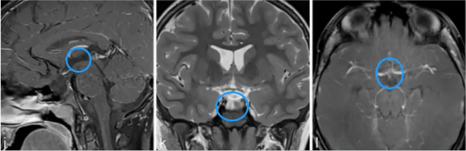 施罗德教授通过神经内镜精准定位肿瘤位置，小心翼翼地剥离肿瘤，全程避开关键神经和组织