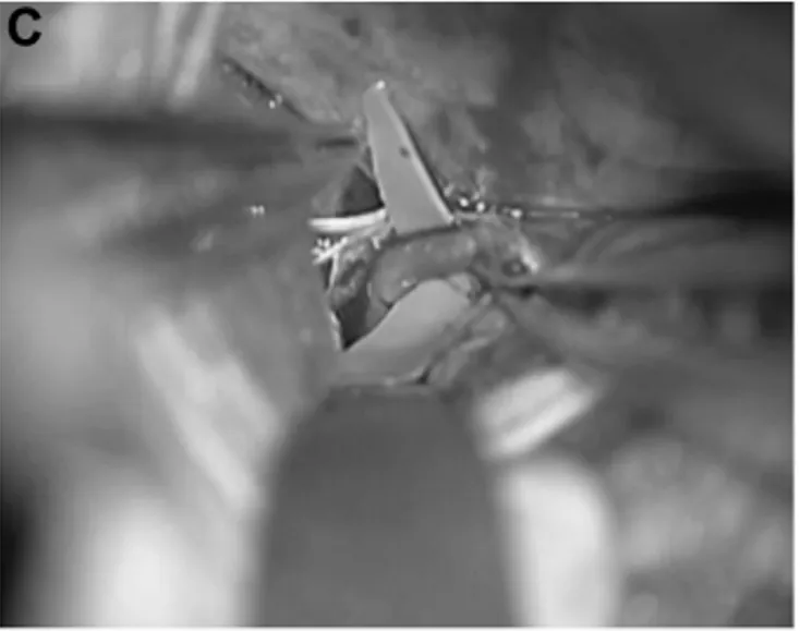 P3 段被选为搭桥血管位置（图 2C 和 2D）