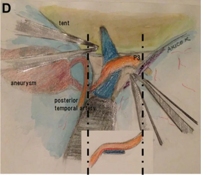 P3 段被选为搭桥血管位置（图 2C 和 2D）