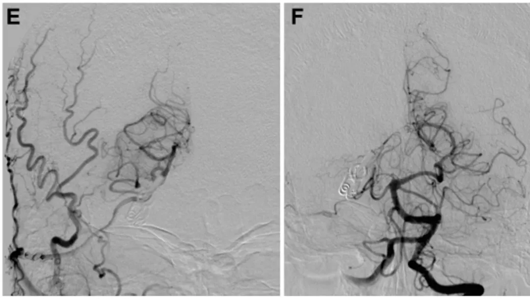 他在动脉瘤破裂前抓住了最后机会，及时手术摘除了隐患