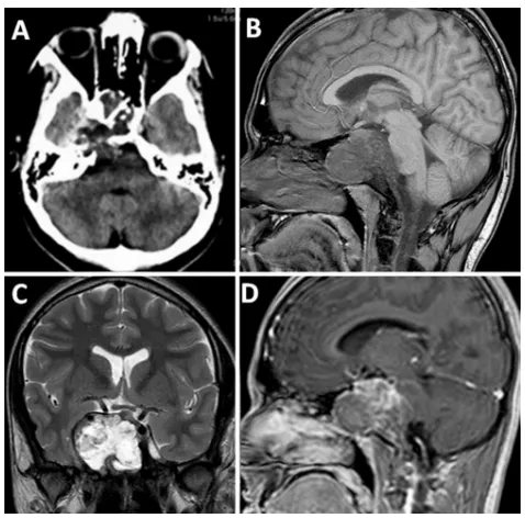 术前：头颅CT扫描显示一巨大病变，侵蚀颅底骨质结构并侵犯右侧中颅窝。脑部磁共振成像证实，该肿瘤在T1加权像上呈低信号，在T2加权像上呈高信号，并在钆剂注射后呈现对比增强。
