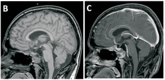 术后：术后矢状位T1加权平扫及增强磁共振成像，证实肿瘤已获完全切除。