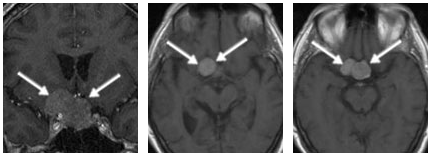 侵袭性垂体瘤能治好吗？侵犯海绵窦，也能实现全切与功能保全