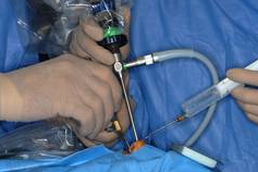 神经内镜下经鼻蝶入路手术