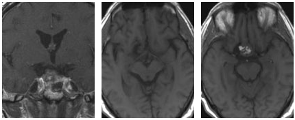 术后MRI结果显示，该患者的肿瘤已完全切除，且使用了脂肪组织进行了封闭处理。