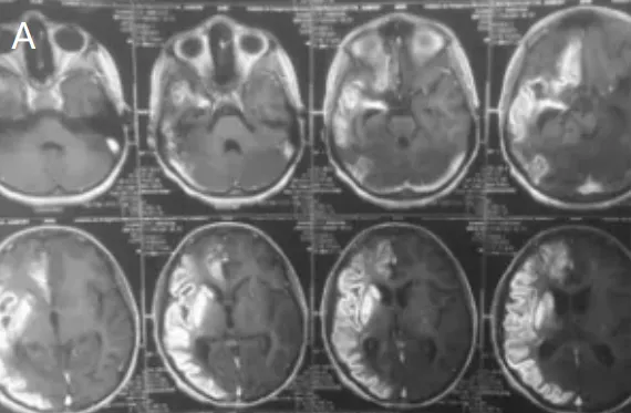 右大脑中动脉、右大脑前动脉供血区已经出现急性缺血（A）
