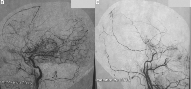 双侧颈内动脉、右侧眼动脉远端和后交通动脉远端完全堵住闭塞