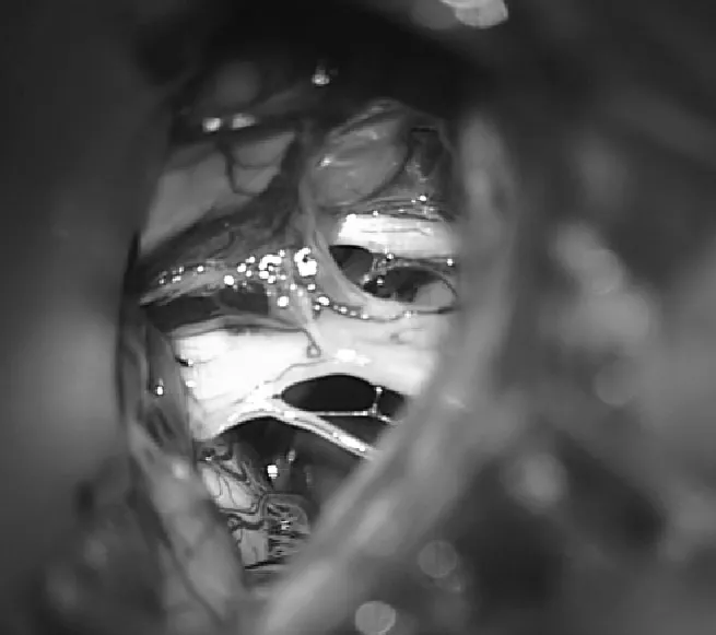 术中影像，与图1相同病例，囊肿开孔并广泛切除囊肿壁后拍摄。外展神经和神经线VII-VIII复合体完全被剥离并减压。