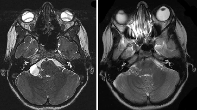 术前（左）和术后（右）T2加权磁共振图像，显示右侧CPA区蛛网膜囊肿（左）及术后6个月小脑完全复扩（右）。
