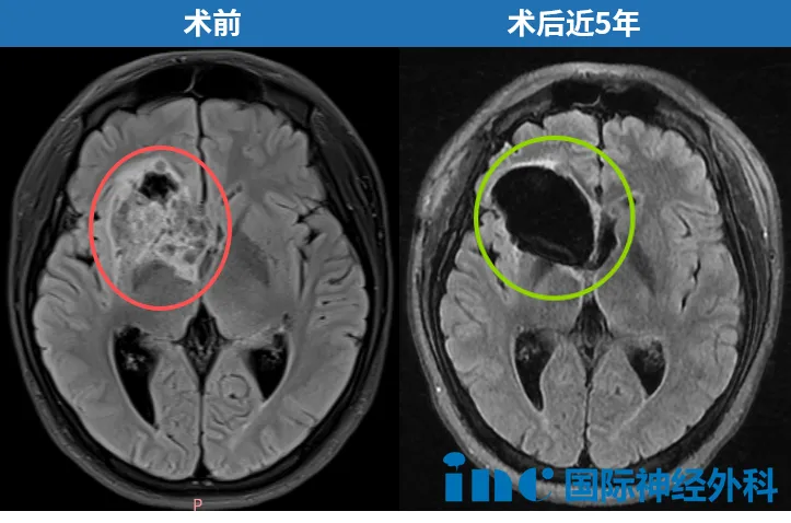 术前术后MRI对比