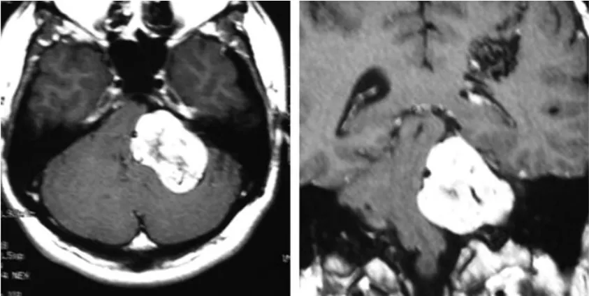 首次就诊时的轴位CT（左）和增强冠状位 T1 加权MRI（右）  显示左侧桥小脑角区肿瘤并脑干受压