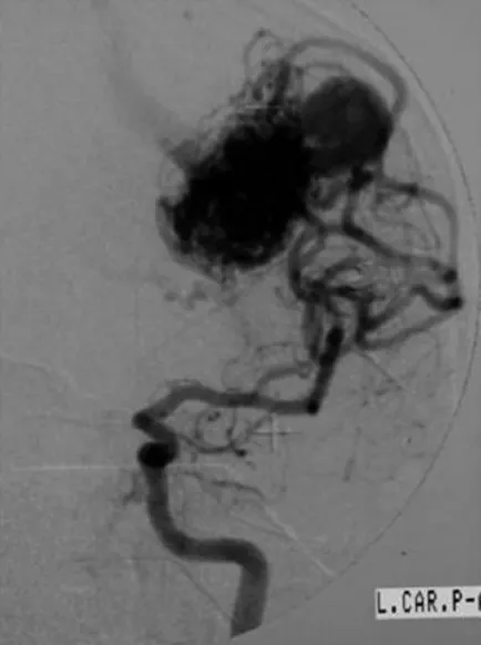 左侧颈内动脉造影数字减影图像  显示左侧顶叶深部动静脉畸形