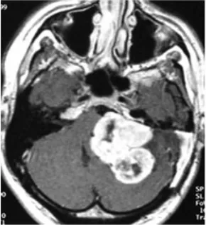 1999 年增强轴位 T1 加权磁共振成像，显示肿瘤复发