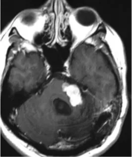 影像学检查显示肿瘤病灶稳定