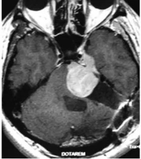 术后 3 个月肿瘤迅速、侵袭性复发，压迫脑干