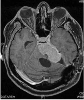 末次手术后 1 个月，残余肿瘤再次侵袭性生长  严重压迫脑干并最终导致患者死亡