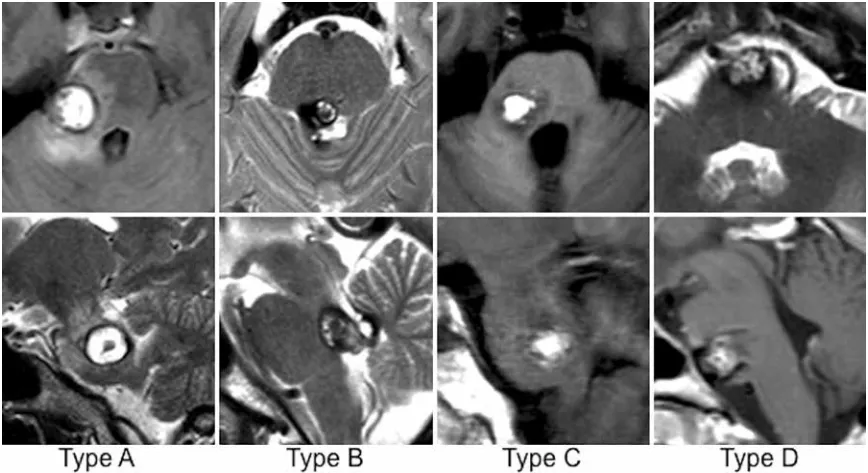 四类桥<a href='/naoxueguanliu/' target='_blank'><u>脑海绵状血管瘤</u></a>类型 