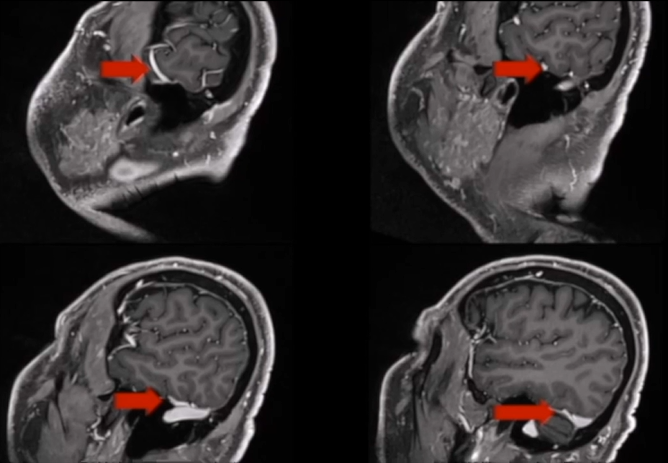 肿瘤出现钙化。