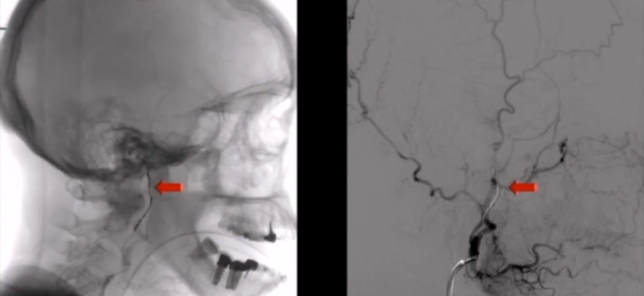 术前血管栓塞。