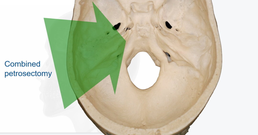 肿瘤与脑干之间的精细解剖