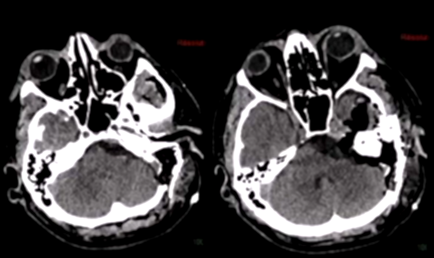 术后CT无任何并发症。