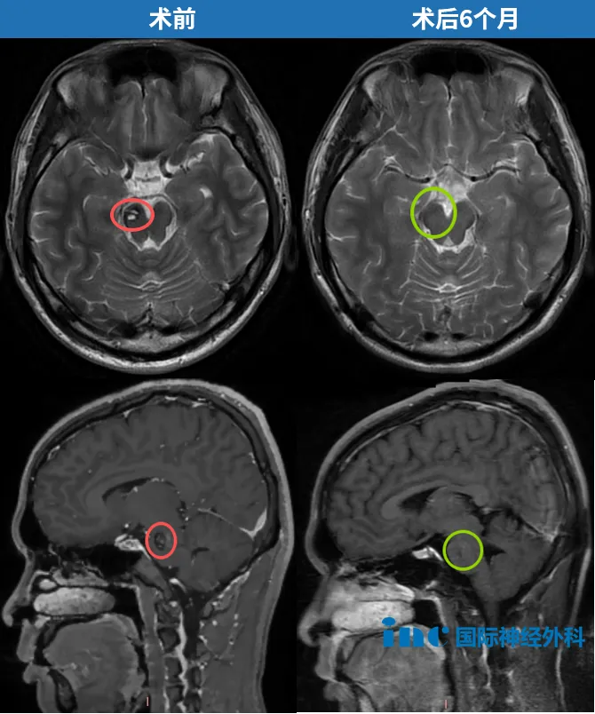 术前术后MRI对比