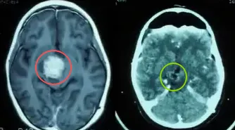 毛细胞星形细胞瘤，WHO 1级