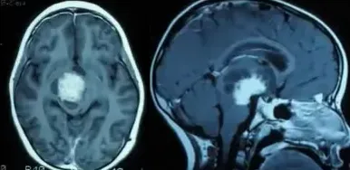 小乐被查出中脑被盖占位，怀疑是胶质瘤