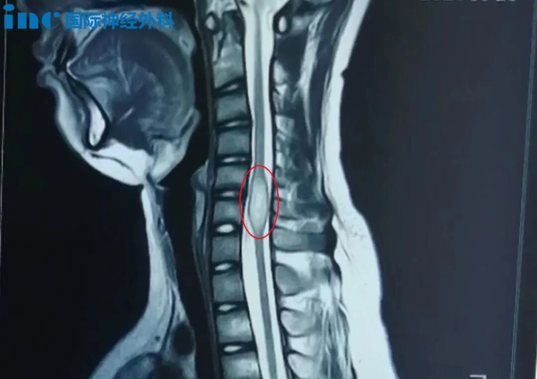 “为什么我不能现在做手术？”同为脊髓肿瘤，为何有的要尽快手术，有的则要暂缓？