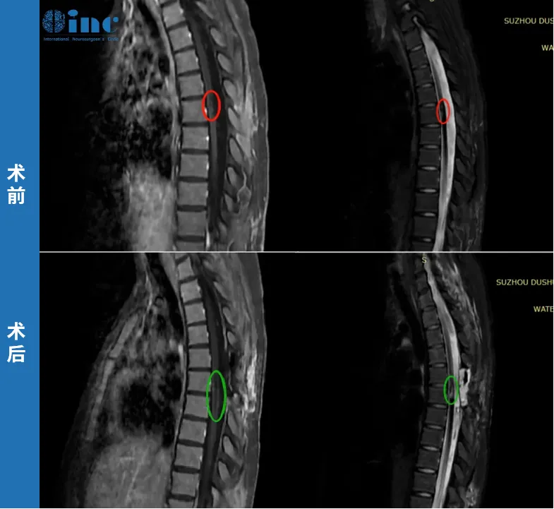 脊髓血管瘤二次出血