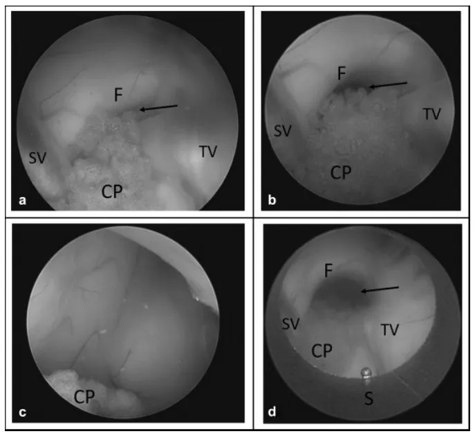 使用光学套管针及鞘管扩张小型室间孔。 (a) 室间孔过小，无法通过鞘管。在内镜直视下，将鞘管定位于室间孔中央，随后小心向前推进至第三脑室内。将鞘管退回到侧脑室后，可见扩张后的室间孔及结构完整的穹窿。箭头指示室间孔。缩写：CP，脉络丛；F，穹窿；S，内镜鞘；SV，隔静脉；TV，丘纹静脉。