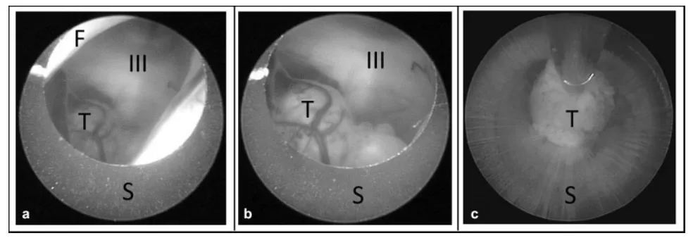 (a) 为观察鞘管边缘，将内镜向鞘管内回缩。 (b) 随后，在内镜直视下（观察穹窿、静脉及脉络丛以避免意外损伤），将鞘管引入第三脑室。 (c) 若肿瘤碎块过大无法通过主工作通道，术者可钳住肿瘤碎块，将其连同整个脑室镜一起从留置在脑内的鞘管中取出。缩写：III，第三脑室；F，穹窿；S，内镜鞘；T，肿瘤。
