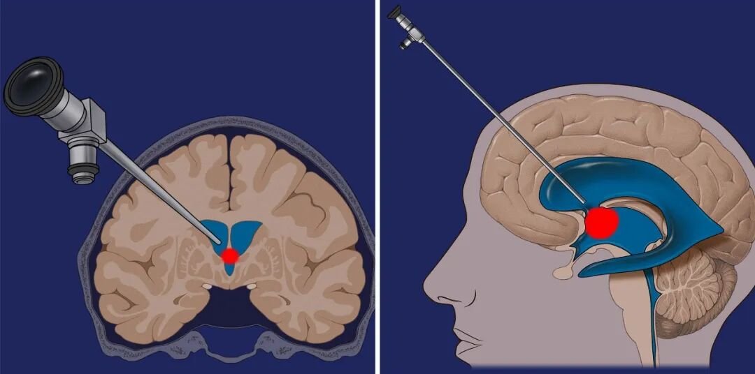 图：根据磁共振成像（MRI）规划手术入路，手术轨迹绕过尾状核头。