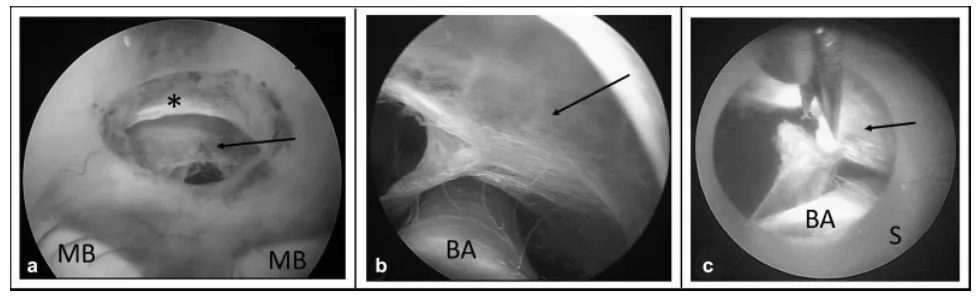 合并桥前蛛网膜的内镜下第三脑室造瘘术。 (a) 第三脑室造瘘术后，透过宽敞的脑室造瘘口及已开窗的Liliequist膜可见深部蛛网膜。 (b) 将LITTLE LOTTA脑室镜的鞘管经脑室造瘘口向前推进后，可见基底动脉及蛛网膜。 (c) 在内镜鞘保护基底动脉的同时，用剪刀切开蛛网膜。箭头指示桥前蛛网膜；星号指示Liliequist膜。缩写：BA，基底动脉；MB，乳头体；S，内镜鞘。