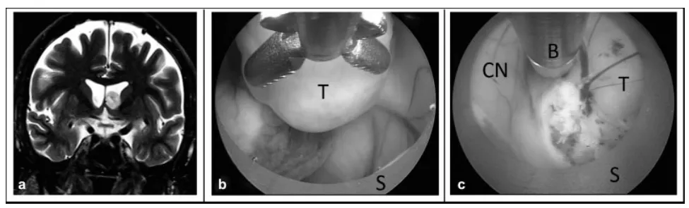 狭窄脑室内的内镜肿瘤切除术。 (a) 冠状位T2加权磁共振图像显示侧脑室内肿瘤，脑室空间狭小。 (b) 将内镜向鞘管内回缩，以创造额外工作空间。 (c) 使用鞘管将肿瘤从尾状核牵开，以便显露肿瘤基底并用双极电凝处理。缩写：B，双极电凝电极；CN，尾状核；S，内镜鞘；T，肿瘤。