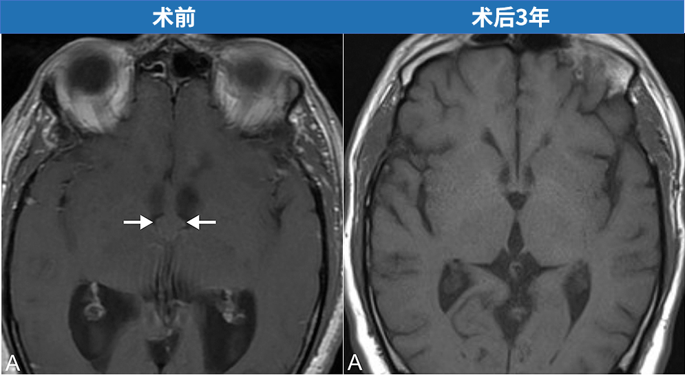 术后三年随访显示囊肿完全切除，无复发。
